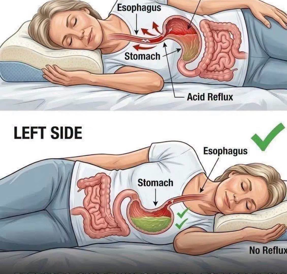 Sleeping on Your Left Side: Can It Really Help With Acid Reflux? 856080060_1103842442369854_8962854867996075761_n