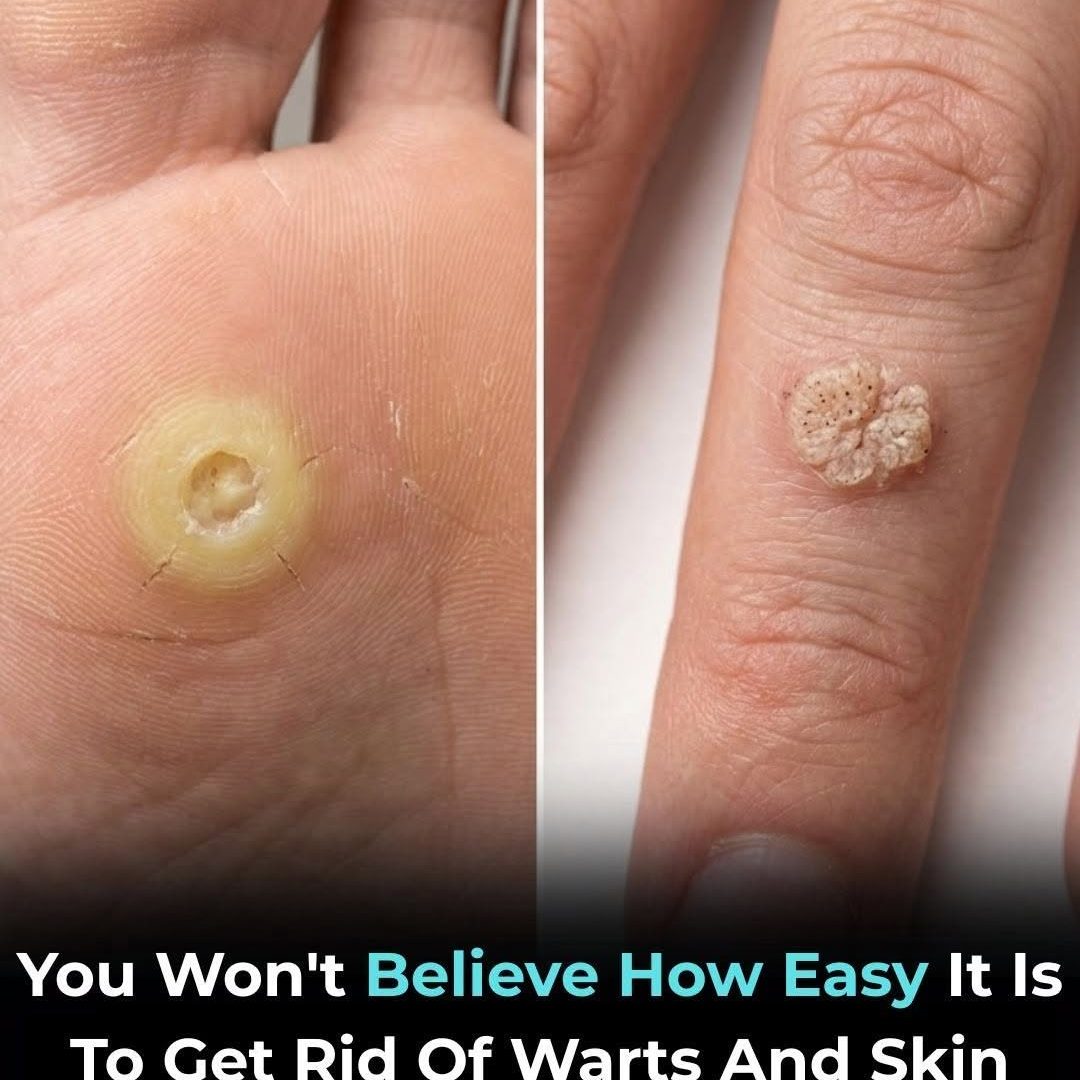 Want to Remove Skin Tags and Warts? Here’s What You Should Know 856411611_1641817610645394_611912120713933066_n